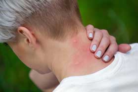 Insect Sting Allergy Hernando County, FL